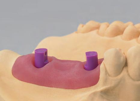 2b I dispositivi di registrazione del morso devono essere sagomati esternamente alla bocca del paziente.
