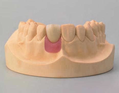 Procedura protesica 6.2.2 Componente Secondaria Anatomica Procedura Protesica La ricostruzione definitiva è consegnata allo studio odontoiatrico sul modello master.
