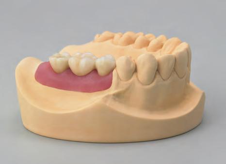Procedura protesica 6.4.2 Componente Secondaria in Oro per ponte Procedura di protesica La ricostruzione definitiva è consegnata allo studio odontoiatrico sul modello master.