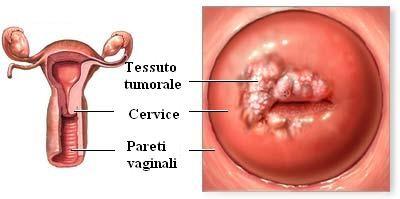 2 Il tumore della cervice uterina è un cancro della sfera genitale femminile che colpisce la parte