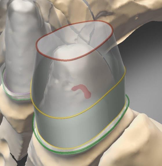 5. Consigli e suggerimenti 1. Utilizzare la funzione di visualizzazione di clip o cursori trasparenti durante la progettazione di corone telescopiche. 2.