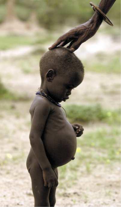 # = Aminoacidi Essenziali * nel bambino # # # # # # (basici) Kwashiorkor (particolare forma di malnutrizione