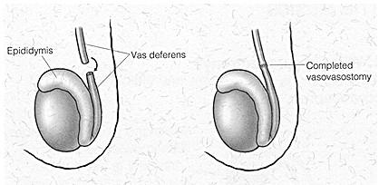 Ostruzione del dotto deferente prossimale VASO VASOSTOMIA Consiste nella anastomosi microchirurgica termino terminale tra i due capi