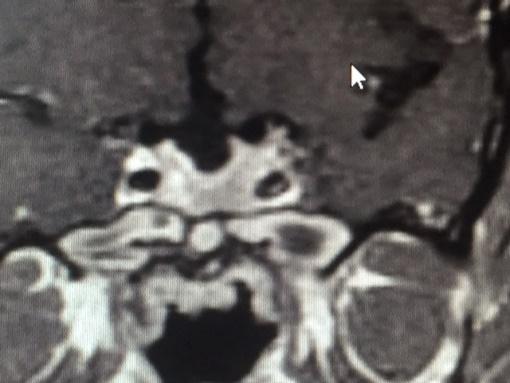 POST- OPERATORIO: DUE MESI DOPO OFF TERAPIA OGTT per GH: 5.2 4.7 4.8-4.5-4.