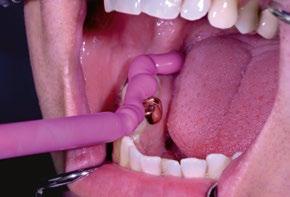 Stabile Elevata tissotropia, quindi il materiale non defluisce negli spazi interdentali, ma rimane stabile sul dente.