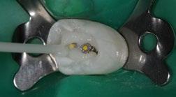 Il fissaggio adesivo (rispetto a quello convenzionale) offre il vantaggio di produrre un'unità composta da dente, perno e ricostruzione del moncone.