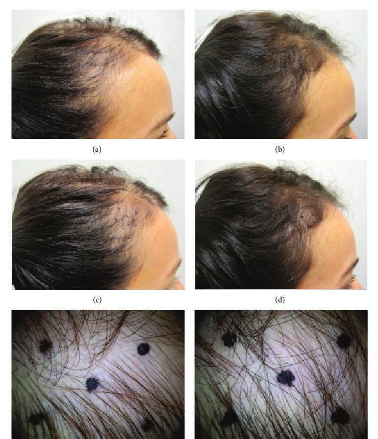 STUDI CLINICI VIVISCAL A 3-Month, Randomized, Double-Blind, Placebo-Controlled Study Evaluating the Ability of an Extra-Strength Marine Protein Supplement to Promote Hair Growth and Decrease Shedding
