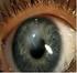 occhio e visione Il trapianto di cornea