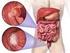 Valutazione anatomo- patologica dei tumori del colon-retto