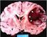 Cos è un tumore cerebrale