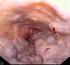 Emorragie massive del tratto gastro-intestinale inferiore