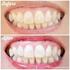 Sbiancamento dentale: case report