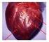 L Infarto Miocardico Acuto con tratto ST sopraslivellato: dal territorio al Laboratorio di Emodinamica