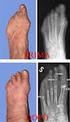 GLI ESITI DELLA CHIRURGIA DELL ALLUCE VALGO SUI METATARSI ESTERNI THE OUTCOME OF THE SURGERY OF HALLUX VALGUS ON EXTERNAL METATARSALS