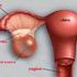 Masse ovariche e TC: chirurgia e clinica