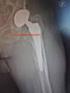 Le fratture periprotesiche di femore dopo una protesi totale d anca