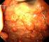 Il gastrinoma è un raro tumore neuroendocrino che. insorge abitualmente nel duodeno o nel pancreas, anche se