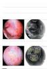 A.E. Salvi 1, G.P. Metelli 1, 2,R.Ascari 3,R.De Vitis 4,A.Chessa 5,M.Corona 5 Second look artroscopico post-mosaicoplastica