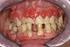Chirurgia orale nei pazienti in terapia con bifosfonati orali