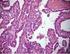 Raro caso di Tumore pseudo-papillare papillare del pancreas in età pediatrica