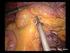 Chirurgia laparoscopica del colon-retto