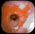 Gastrite. MRGE (con Esofagite Erosiva) Ulcera Gastrica. Malattia Peptica o M. Acido-correlate Duodenite. Ulcera Duodenale