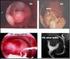 Miomectomia isteroscopica: risultati a lungo termine sui pattern mestruali e sull outcome riproduttivo
