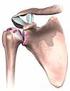 I vantaggi delle protesi di spalla senza stelo omerale: dai primi impianti, passando per le revisioni fino alla desescalade