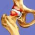 L IMPINGEMENT FEMOROACETABOLARE (FAI).