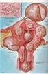 Fibromatosi uterina: implicazioni per la salute e la sessualità