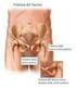 Frattura complessa dell arco pelvico in donna gravida