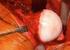 Angolo cervico diafisario e off-set femorale: indici qualificanti nella biomeccanica della protesi d anca