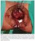 Conventional (CH) vs Stapled Hemorrhoidectomy (SH) in surgical treatment of hemorrhoids Ten years experience