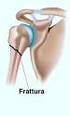 FRATTURE DELL OMERO PROSSIMALE: OSTEOSINTESI CON PLACCA A STABILITA ANGOLARE PROXIMAL HUMERAL FRACTURES: LOCKING PLATE OSTEOSYNTHESIS