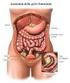 DONNE E CARCINOMA OVARICO