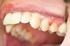 Patologie correlate all esposizione dei colletti dentali: ipersensibilità dentinale e carie radicolare
