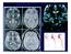 Emerging evidence of systemic diseases. Filippini et al., Neurology, 2010