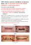 PDF 6. Estetica protesica riabilitativa in situazioni limite, cioè recuperando denti, molto distrutti (fratturati o cariati sottogengiva).